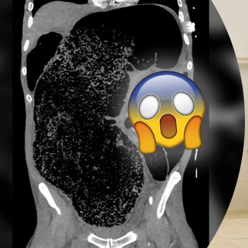 Man Left Paralysed And Close To Death Due to Ginormous Poop