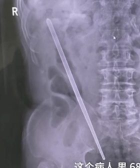 68 Year Old Man Gets Chopstick Stuck Up His Bum After Inserting It "Out Of Curiosity"