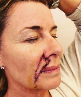 Deborah Hutton Shares Pictures Of Her Scars Following Skin Cancer Removal