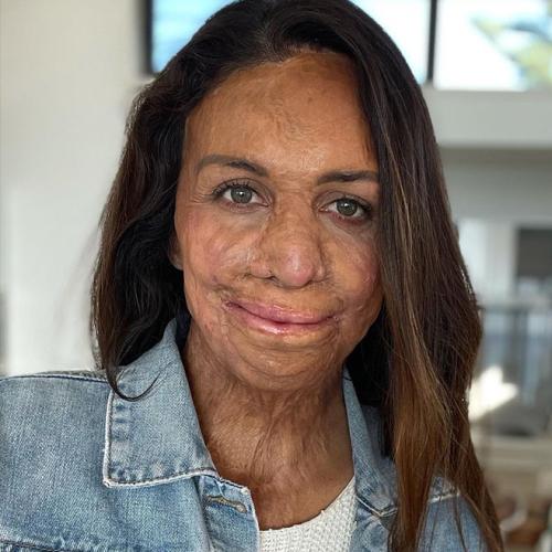 Turia Pitt Marks 10 Years Since The Terrifying Day That Changed Her Life